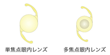 単焦点眼内レンズと多焦点眼内レンズ