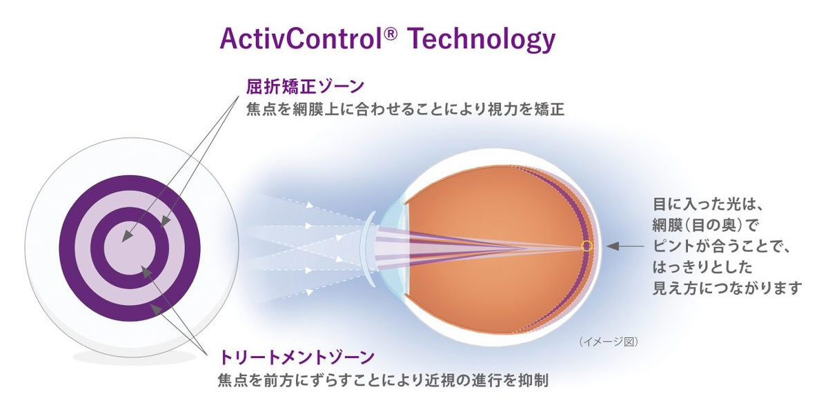 デュアルフォーカス（二重焦点）設計　イメージ