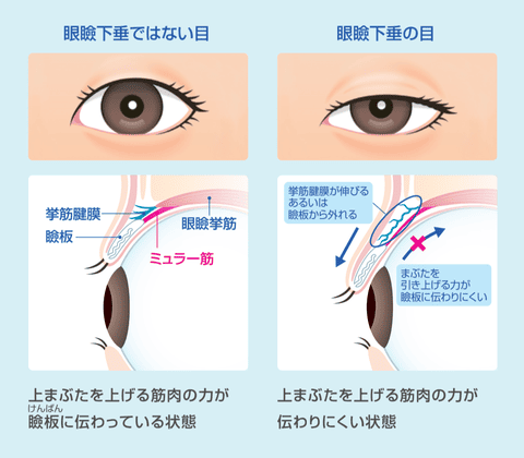 『眼瞼下垂』が起こるしくみ（腱膜性眼瞼下垂の場合）