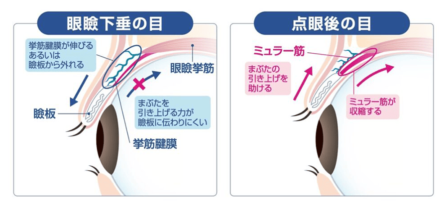 アップニーク ミニ点眼液0.1％の作用機序
